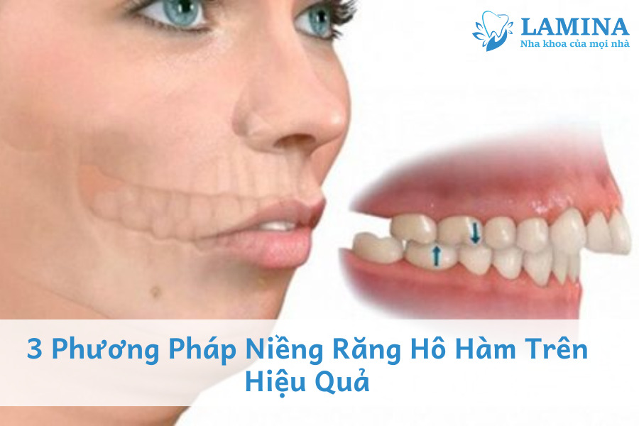 Phương pháp niềng răng hô hàm trên hiệu quả