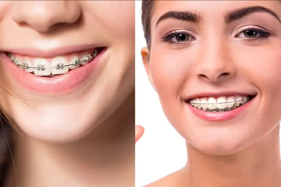 Mỗi loại mắc cài là đều sở hữu những ưu, nhược điểm riêng