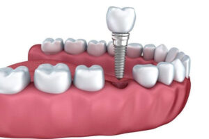 Trụ răng tốt sẽ đảm bảo khả năng tương thích với xương hàm cao
