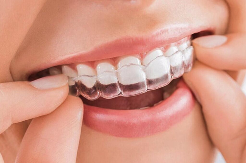 niềng răng trong suốt Lamina