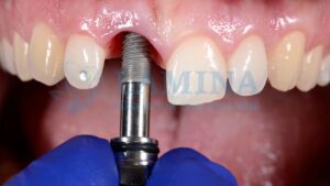 Quy trình trồng răng Implant