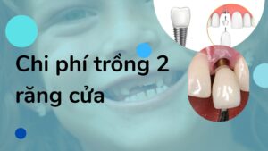Chi Phí Trồng 2 Răng Cửa