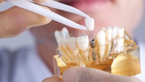 Trồng răng Implant khuyến mại