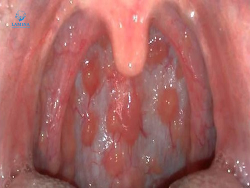 hôi miệng từ cổ họng: viêm cổ họng