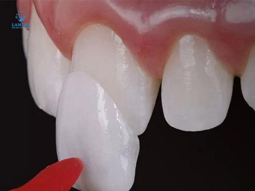 men răng vàng: dán sứ veneer