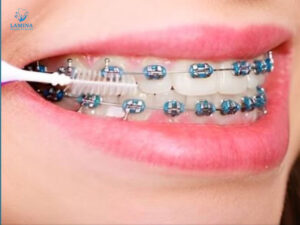 niềng răng mắc cài cánh cam vệ sinh