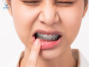 niềng răng mắc cài cánh cam đau nhức