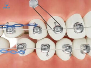 niềng răng mắc cài cánh cam thẩm mỹ