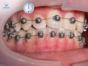 niềng răng mắc cài cánh cam thời gian điều trị nhanh