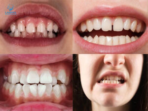 trường hợp cần niềng răng mắc cài cánh cam