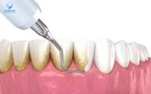 răng bị đen trên bề mặt:: lấy cao răng định kỳ