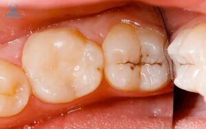 răng bị đen trên bề mặt: sâu răng