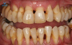 răng bị đen trên bề mặt:: tụt hở lợi