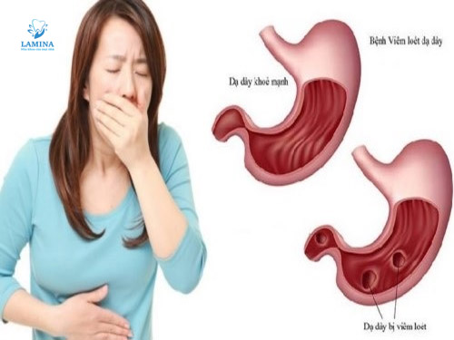 hôi miệng do dạ dày là gì?