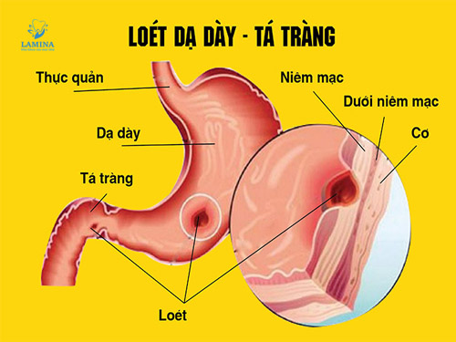 hôi miệng do dạ dày viêm loét