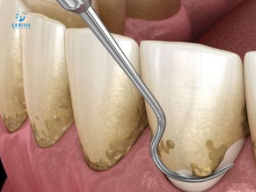 lấy cao răng bao nhiều tiền: dụng cụ thủ công