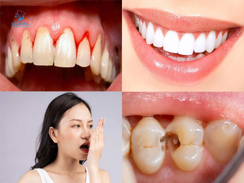 lấy cao răng bao nhiều tiền: Lợi ích lấy cao răng