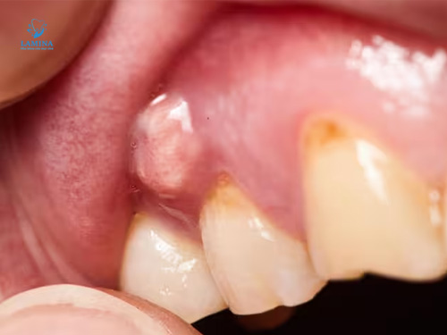 lấy cao răng bao nhiều tiền: viêm nướu