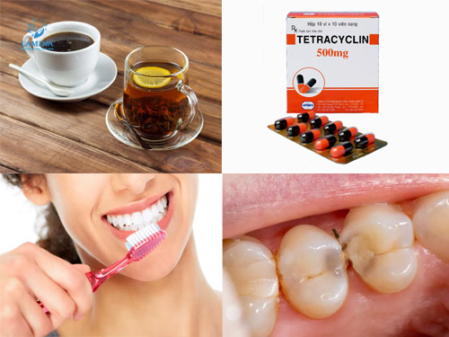 Nguyên nhân răng bị đen