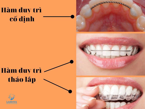 niềng răng có được vĩnh viễn không hàm duy trì