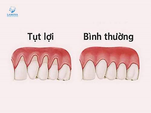 răng bị tụt lợi là gì