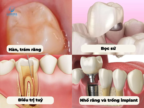 Răng số 7 bị sâu vỡ: Cách xử lý