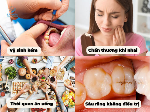 Răng số 7 bị sâu vỡ: Nguyên nhân