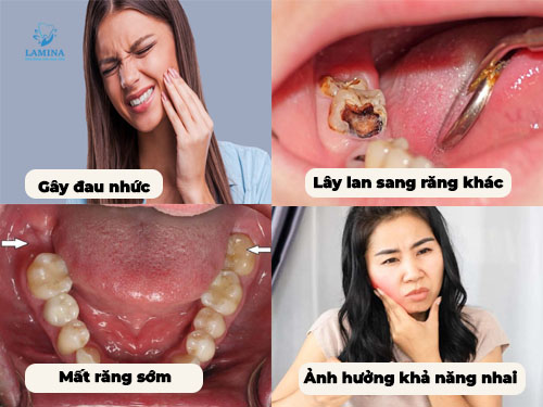 Răng số 7 bị sâu vỡ: tác hại