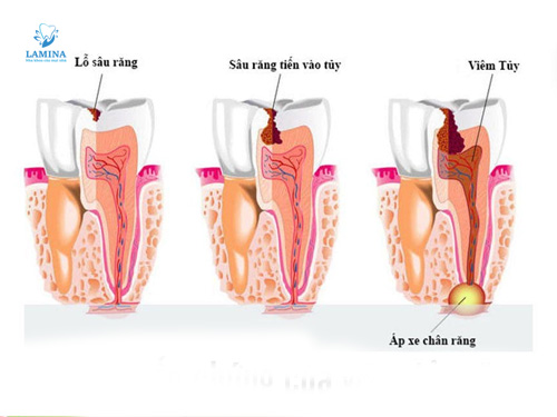 biến chứng răng số 8