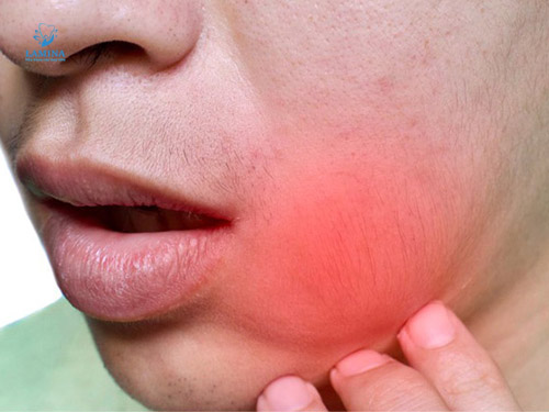 sốt sưng lợi do răng số 8