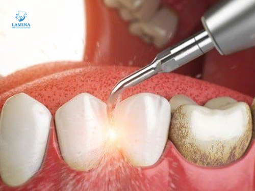 cao răng màu đen máy siêu âm