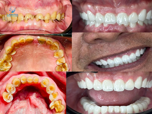 cao răng màu đen thẩm mỹ