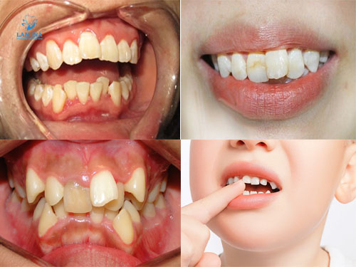 dấu hiệu răng cửa mọc lệch