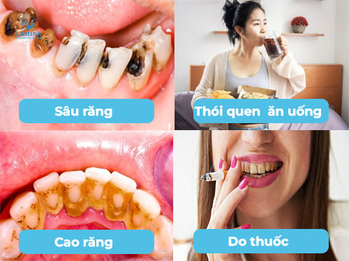 răng có vết đen: nguyên nhân