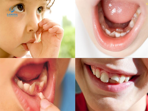 nguyên nhân răng cửa mọc lệch