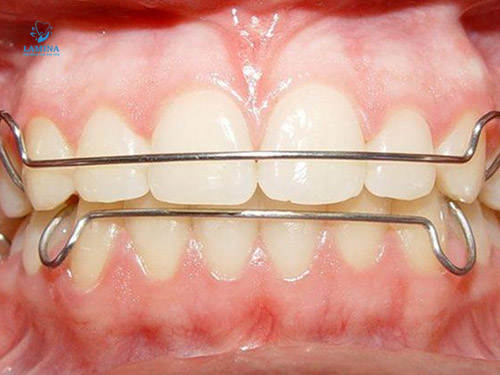 niềng răng cho trẻ 7 tuổi giá bao nhiêu: Khí cụ tháo lắp