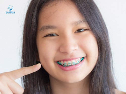 niềng răng cho trẻ 7 tuổi giá bao nhiêu: lý do niềng