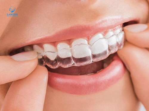 niềng răng cho trẻ 7 tuổi giá bao nhiêu: Niềng răng trong suốt invisalign