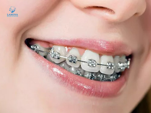 niềng răng cho trẻ 7 tuổi giá bao nhiêu: niềng răng mắc cài kim loại