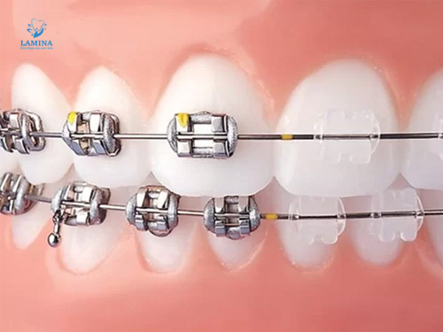 niềng răng cho trẻ 7 tuổi giá bao nhiêu: niềng răng mắc cài sứ