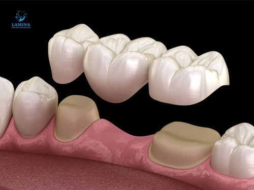 răng cấm có thay không: cầu răng sứ