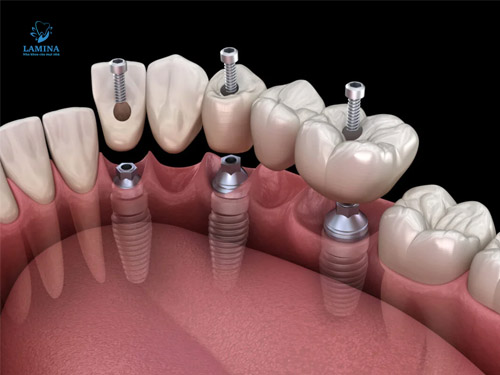 răng cấm có thay không: trồng răng implant
