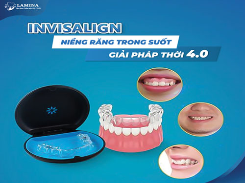 niềng răng khi răng cửa mọc lệch