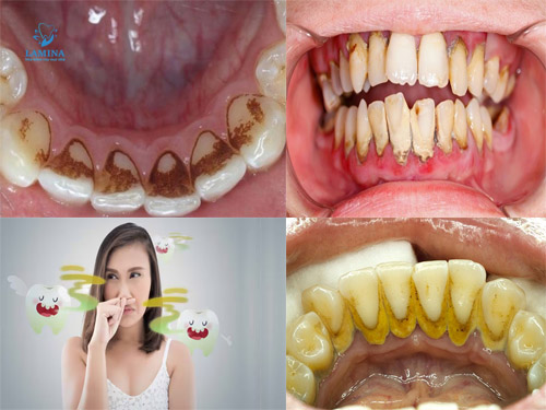 tác hại cao răng màu đen