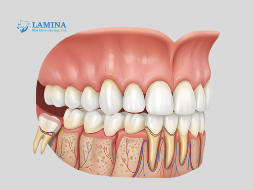 Nhổ răng khôn 2 tháng vẫn đau – cảnh báo bất thường bạn không nên bỏ qua