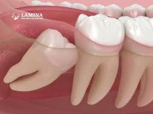 Nhổ răng khôn 2 tháng vẫn đau – cảnh báo bất thường bạn không nên bỏ qua