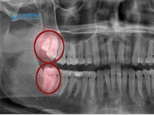 Nhổ răng khôn 2 tháng vẫn đau – cảnh báo bất thường bạn không nên bỏ qua