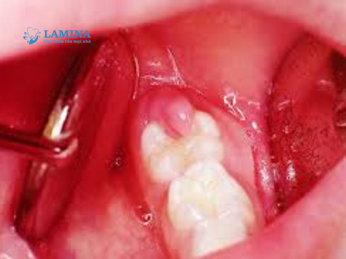 Nhổ răng khôn 2 tháng vẫn đau – cảnh báo bất thường bạn không nên bỏ qua