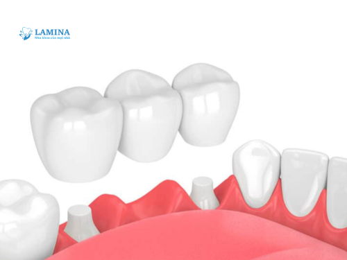 Răng giả bao nhiêu tiền? Cập nhật chi tiết chi phí & lời khuyên từ bác sĩ