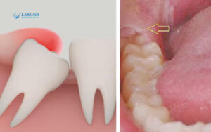 Răng khôn là răng ở đâu Vì sao ai cũng sợ mọc răng khôn